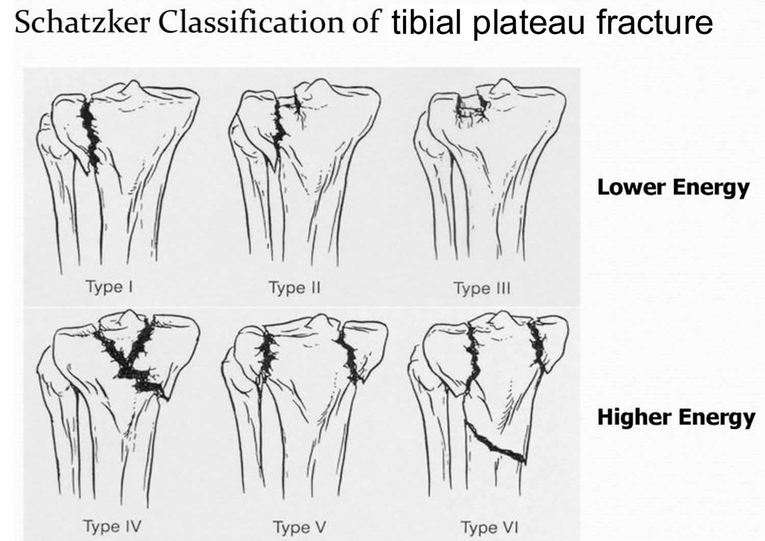 <p>wedge shaped fx of lateral tibial plateau w/ displacement or depression &lt;4mm</p>