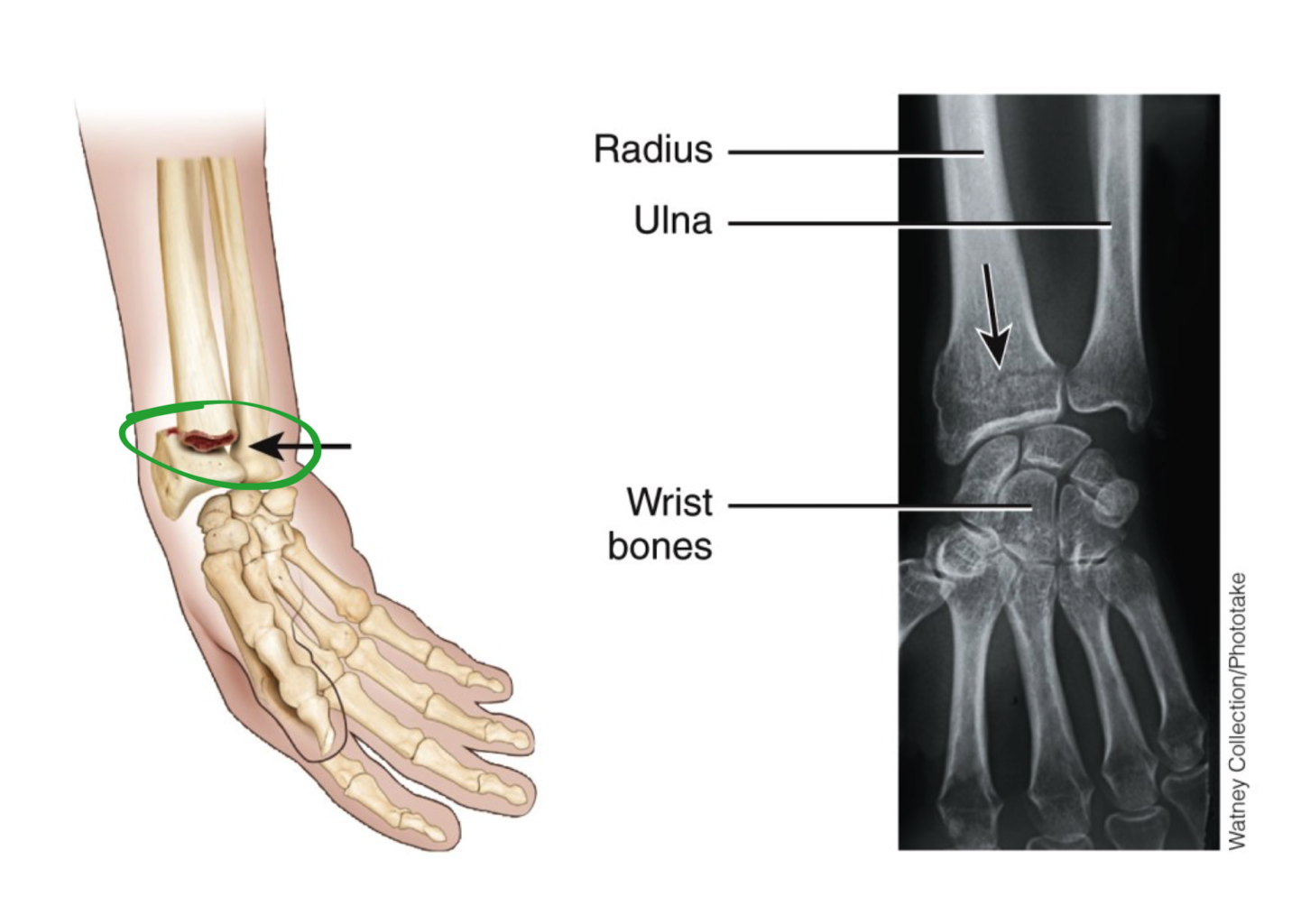 <ul><li><p>wrist bones</p></li><li><p>distal end of radius </p></li></ul>