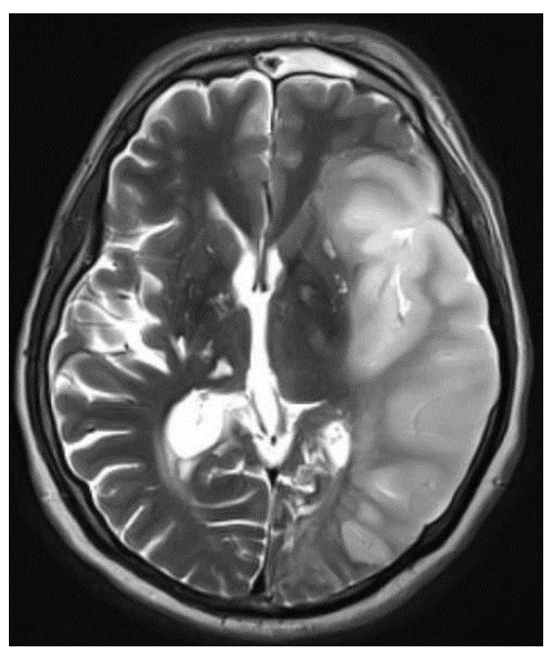 <p>A T2 MRI from a 59-year-old male with sudden onset weakness reveals the result shown in the accompanying image. Which of the following signs/symptoms will most likely be found on physical examination?</p><p>A. Alexia without agraphia</p><p>B. Bitemporal hemianopia</p><p>C. Contralateral neglect</p><p>D. Diplocusis</p><p>E. Dysdiadokinesia</p><p>F. Global amnesia</p>