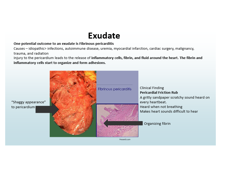 <p>Fibrinous Pericarditis—pericardial friction rub and adhesions</p>