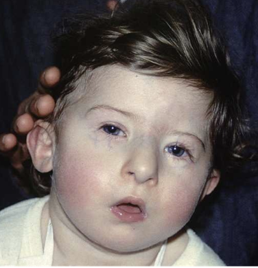 <ul><li><p>DiGeorge syndrome is a complex disease caused by the deletion of a small segment of chromosome 22</p></li><li><p>DiGeorge Syndrome patients have an absent or underdeveloped thymus, which results in the absence of mature T cells</p></li><li><p>in addition to T cell abnormalities, abnormalities in the heart, face, and palate are commonly observed as well as learning disabilities</p></li></ul><p></p>