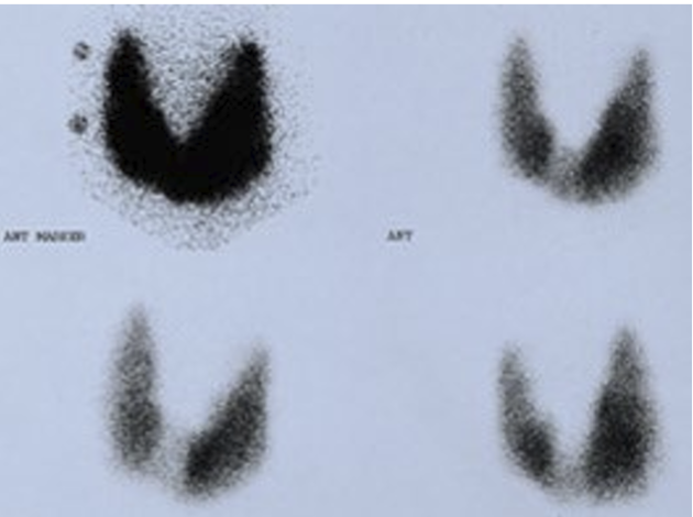 <p>What does this show in what disease</p>