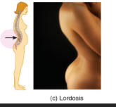 <ul><li><p>swayback</p></li><li><p>caused by an exaggerated lumbar curve which can be caused be pregnancy or pot bellies</p></li></ul><p></p>
