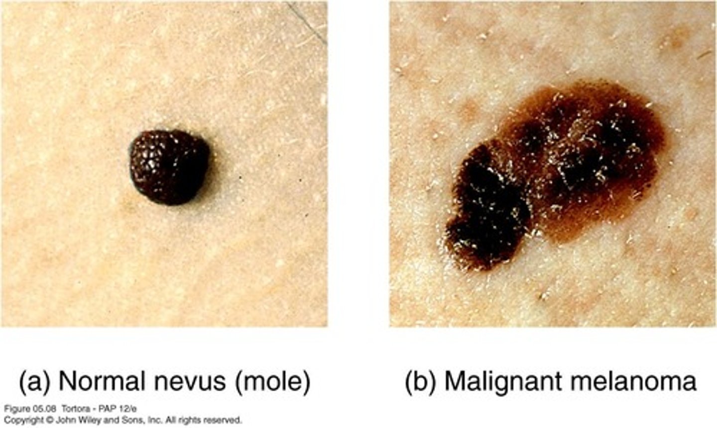 <p>Benign chronic lesions also known as birthmarks.</p>