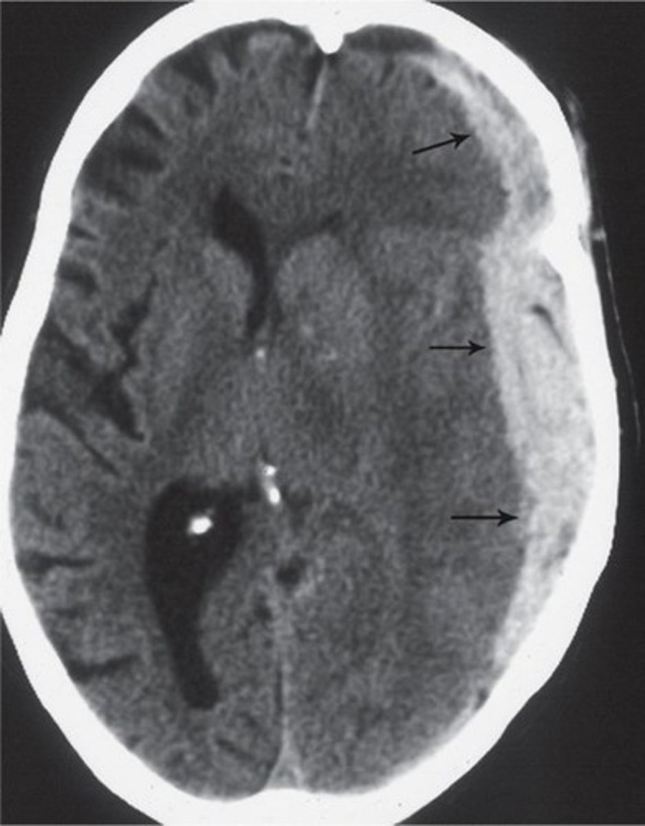 <p>-biconvex</p><p>-midline shift</p><p>-effacement of ventricles</p>