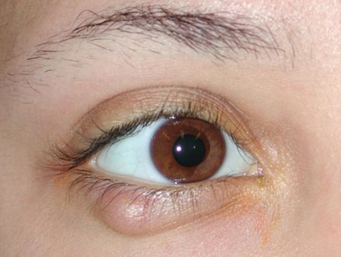 <p>Chalazion</p><p>Painless, cold lid nodule, versus hordeolum, which is a painful infectious "hot" nodule</p>