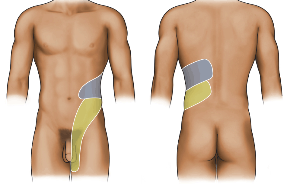 <p>can be caused by hypercalcemia, oxalate-rich foods, dehydration</p><p>parathyroid controls calcium lvl and if calcium is low, the parathyroid will pull more calcium from the bones and the kidneys can’t handle it so calcium calculi form</p><p>Flank pain with radiation into the groin, hematuria, and crystalluria are classic signs of nephrolithiasis.</p>