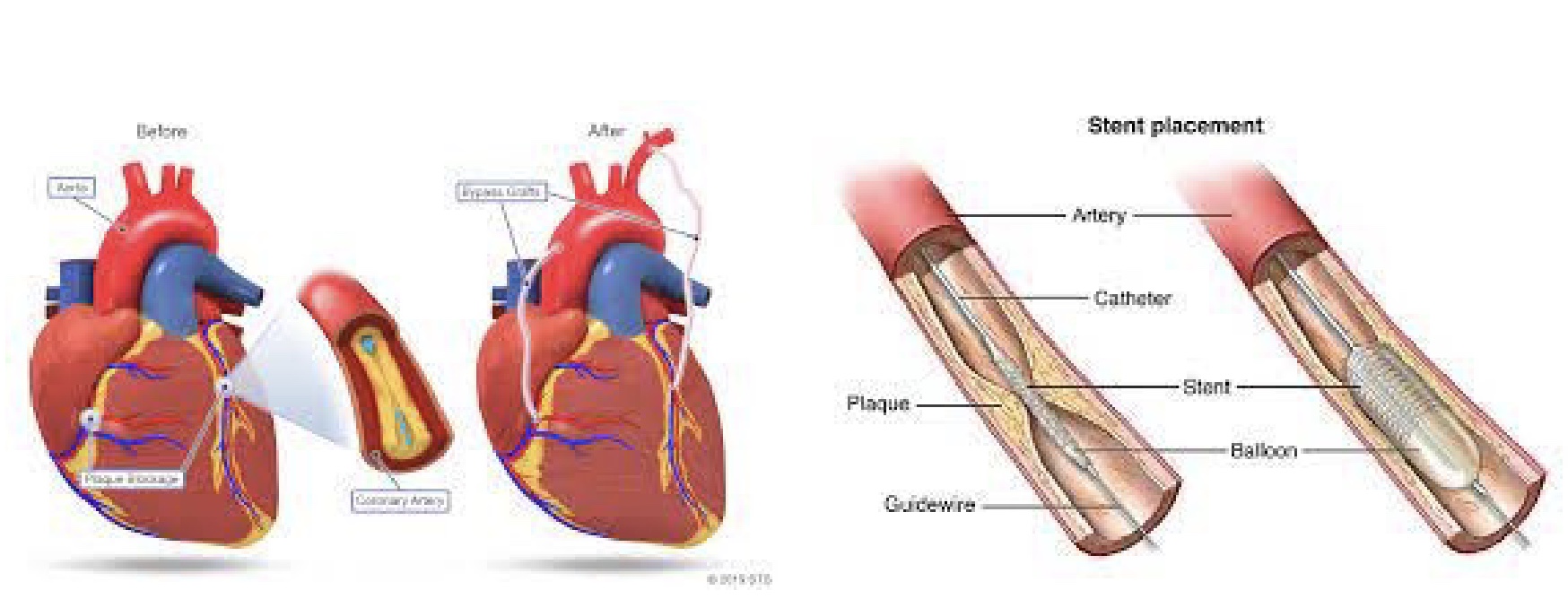 <p><u>Bypass graft</u></p><p>-open up sternum and sew on bypass vessel from aorta to coronary artery; more invasive</p><p><strong>-longer to recover from</strong>, but less restenosis rate</p><p><u>Balloon Stent</u></p><p>-catheter and stent and balloon, “angioplasty”</p><p>-restores blood flow</p><p>-invasive but quick, but not not good if multi-vessel</p>