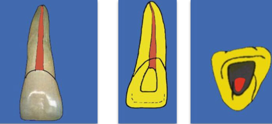 <p>Lingual shoulder</p><p>Calcific metamorphosis</p><p>Root bulkier than lateral</p><p>Lateral canals in middle or apical third</p><p>Dilacerations</p>