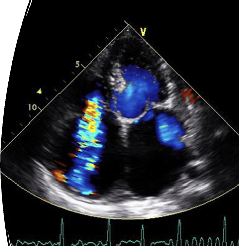 <p><span>is leakage of blood backwards from the right ventricle into the right atrium during <u>systole</u>; may be acute,&nbsp; chronic or intermittent.</span></p>