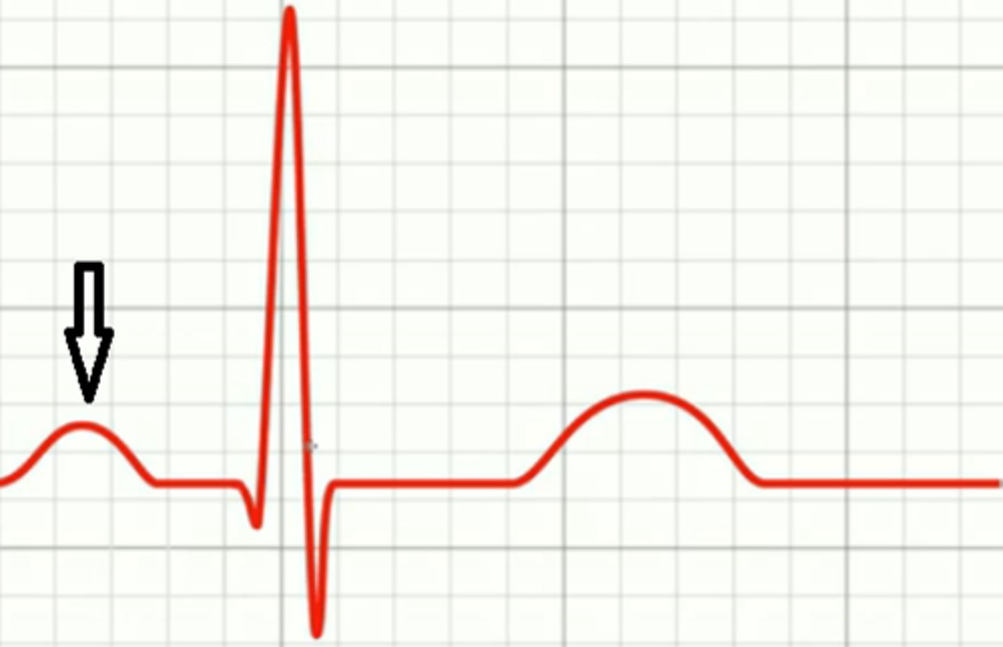 <p>shows depolarization/excitation of atria, followed by atrial systole (contraction)</p>