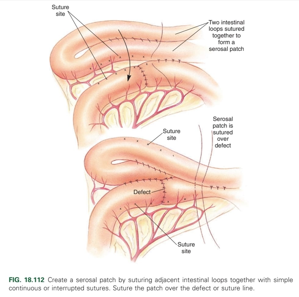 <p>Create a serosal patch over the incision line</p>