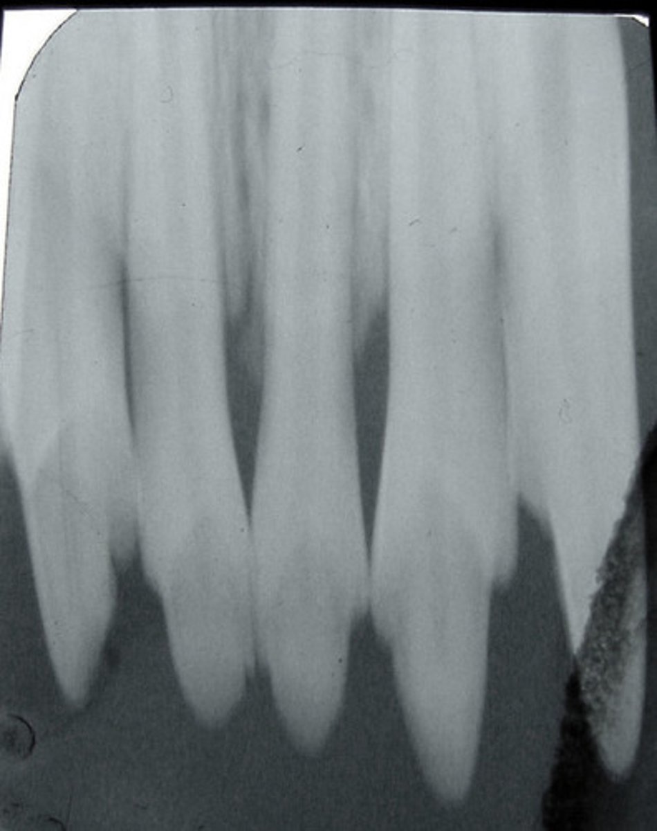 <p>Vertical angulation too low</p>