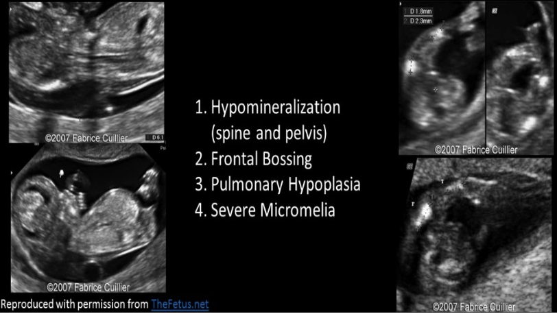 <p>which is <strong>not</strong> expected finding in a fetus w/<strong>achondro<em><u>genesis</u></em></strong></p><p>a) poor vertebral ossification</p><p>b) macrocrania</p><p>c) severe micromelia</p><p>d) oligohydramnios</p>