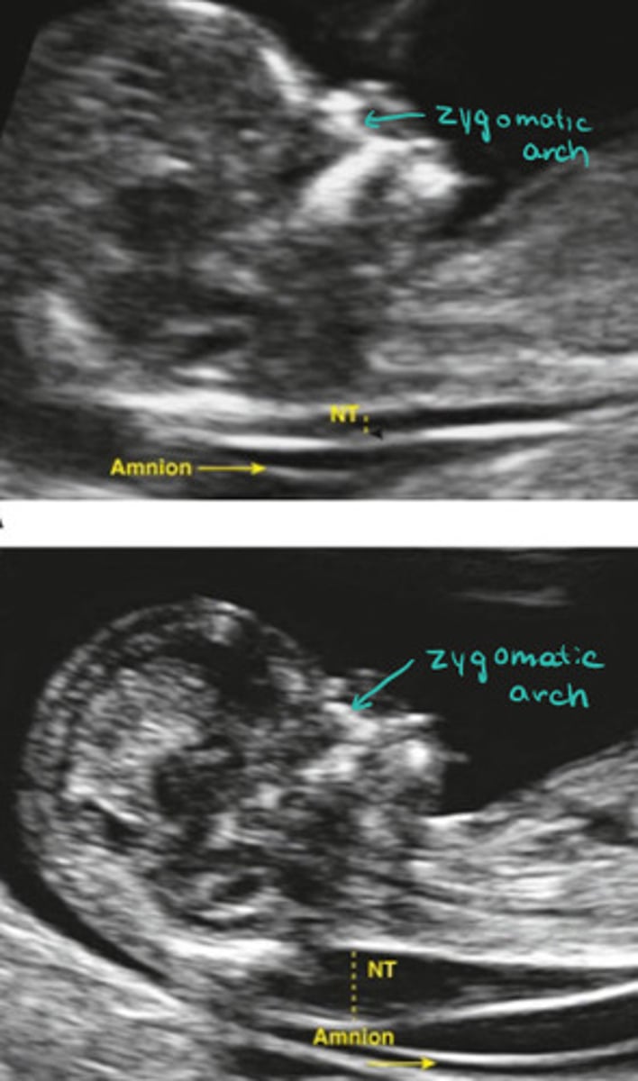 <p>What does it mean if you see the zygomatic arch in the image</p>