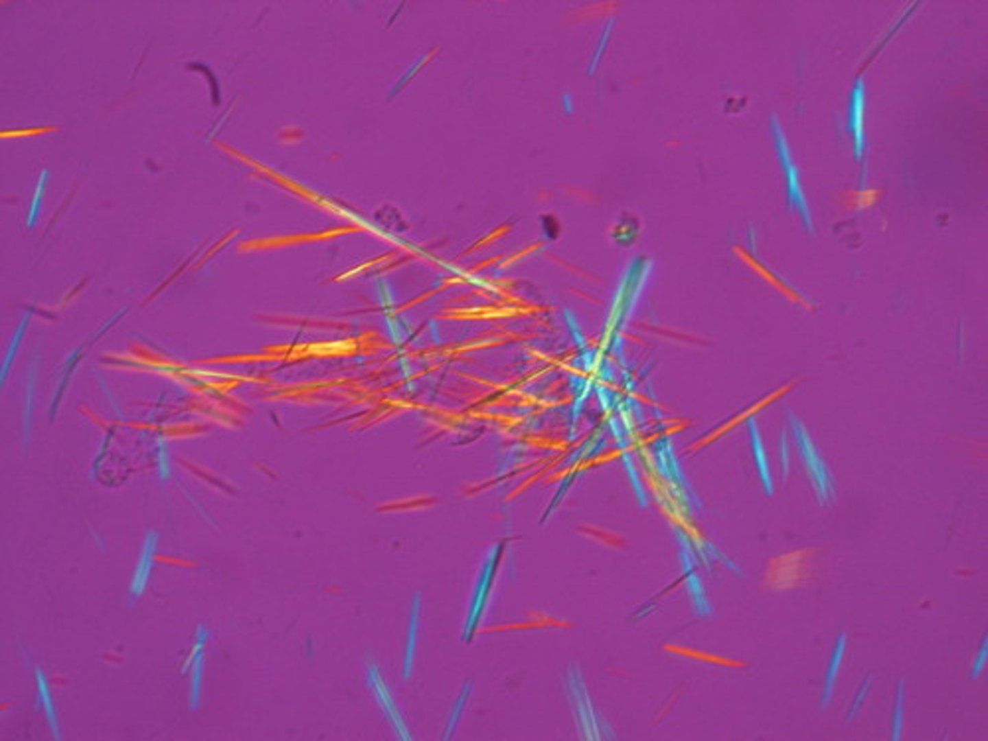 <p>Findings:</p><p>- acute inflammatory monoarthritis caused by precipitation of monosodium urate cyrstals in the joints</p><p>- more common in males</p><p>- associated with hyperuricemia</p><p>- hyperuricemia can be due to</p><p>1. under excretion of uric acid (90% patients) - this is largely idiopathic but can be exacerbated by certain medications</p><p>2. over production of uric acid (10%) - seen with Lesch-Nyhan syndrome, PRPP excess, increased cell turnover (ie: tumor lysis syndrome), von Gierke disease</p><p>Crystal appearance:</p><p>- needle shaped</p><p>- negative birefringent under polarized light (yeLLow under paraLLel light; blue under perpendicular light)</p><p>Symptoms:</p><p>- asymmetric joint distribution</p><p>- swollen, red, painful joint</p><p>- classically MTP joint of the big toe (podagra)</p><p>- tophus (a deposit of crystalline uric acid and other substances at the surface of joints or in skin or cartilage, typically as a feature of gout) formation often on external ear, olecranon bursa or achilles tendon</p><p>- acute attack tends to occur after a large meal or alcohol consumption</p><p>Treatment:</p><p>- acute: NSAIDS (indomethacin), glucocorticoids, colchicine</p><p>- chronic (preventative): xanthine oxidase inhibitors (ie: allopurinol, febuxostat)</p>