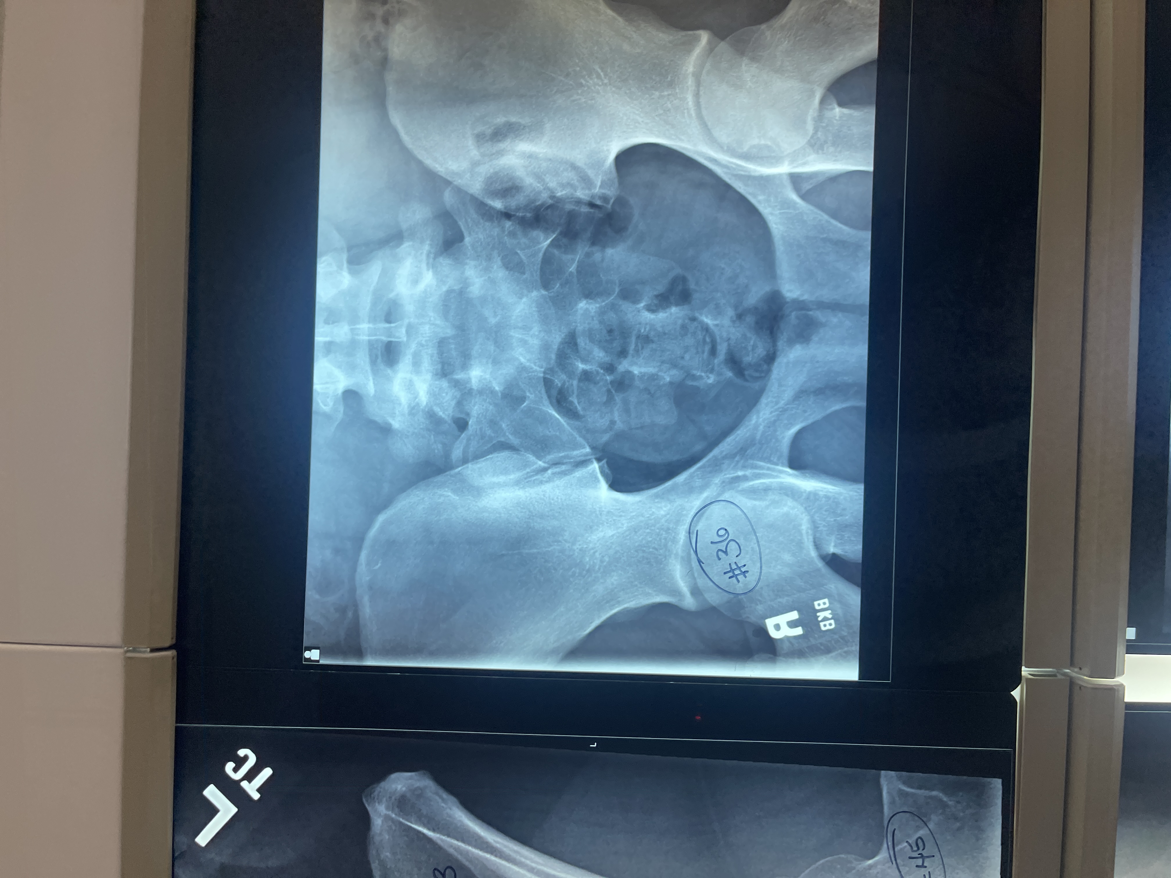 <p>What’s wrong with #36 AP axial sacrum</p>