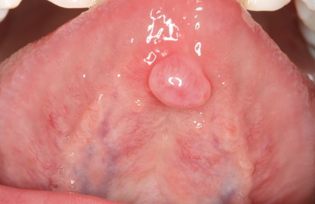 <p>If you have a mucocele on the ventral tongue, what is it called?</p>