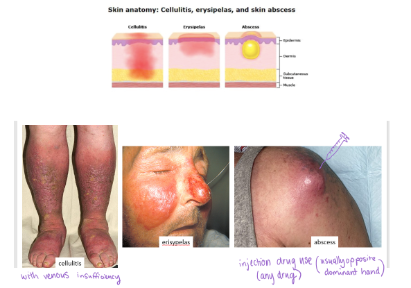 <p>C) Cellulitis — deeper dermal and subcutaneous tissue infection with ill-defined borders, often caused by <em>Streptococcus</em> or <em>Staphylococcus</em> species </p>
