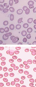 <p>Hypochromia</p>