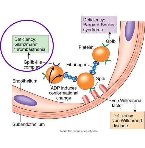 <ul><li><p><span style="color: red"><strong>von Willebrand Disease</strong></span></p><ul><li><p>Normal aggregation w/ all agonists <strong>except ristocetin</strong></p></li><li><p>Ristocetin abnormal <span style="color: yellow">(corrects w/ normal plasma)</span></p></li></ul></li><li><p><span style="color: rgb(238, 114, 11)"><strong>Bernard-Soulier Syndrome</strong></span></p><ul><li><p>Normal aggregation w/ all agonists <strong>except ristocetin</strong></p></li><li><p><span style="color: yellow"><strong>No correction</strong> with normal plasma (due to GPIb defect)</span></p></li></ul></li><li><p><span style="color: rgb(48, 230, 11)"><strong>Glanzmann Thrombasthenia</strong></span></p><ul><li><p><strong>Absent aggregation</strong> with all agonists <strong>except ristocetin</strong></p></li><li><p>Ristocetin: normal (does not require GPIIb/IIIa)</p></li></ul></li></ul><p><strong>Key Mechanisms</strong>:</p><ul><li><p><span style="color: red">vWD: ↓ vWF (defective ligand)</span></p></li><li><p><span style="color: rgb(236, 109, 12)">Bernard-Soulier: ↓ GPIb (defective receptor)</span></p></li><li><p><span style="color: rgb(35, 241, 7)">Glanzmann: ↓ GPIIb/IIIa (defective fibrinogen receptor for aggregation)</span></p></li></ul><p></p>