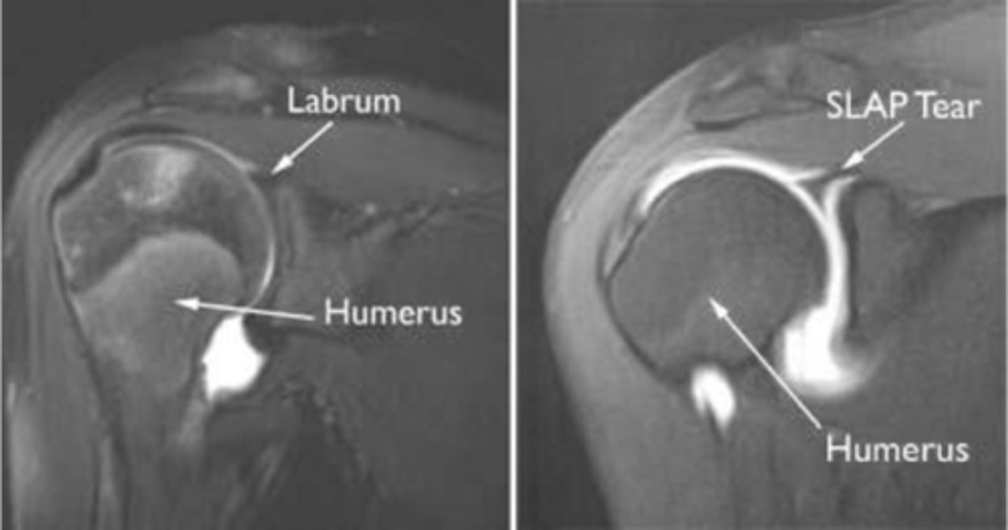 <p>Two questions for you on this one: why do we know there a labral pathology present? (1) and why is this NOT adhesive capsulitis? (2)</p>