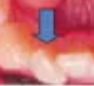 <p>tooth twisted or rotated or turned </p>