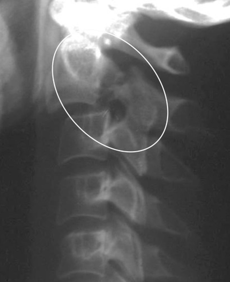 <p>What type of spondy is this?</p>