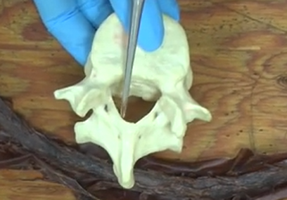 <p>The space outside the dura mater, between the dura mater and the vertebral wall.</p>