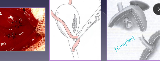 <ul><li><p><span style="color: rgb(136, 136, 136);"><strong>Et:</strong></span><span><strong> </strong>empties abnormally, unilateral urethra most common</span></p><ul><li><p><span><strong>Intramural: </strong>tunnels submucosally, exits urethra/vagina</span></p></li><li><p><span><strong>Extramural: </strong>bypasses bladder completely</span></p></li></ul></li><li><p><span style="color: rgb(136, 136, 136);"><strong>Sig:</strong></span><span> young <u>female</u>, Husky, Golden, Lab, Newfie, Poodle, Bulldog</span></p></li><li><p><span style="color: rgb(136, 136, 136);"><strong>Cs:</strong> </span><span>incontinence, urine scald, recurrent UTIs</span></p></li><li><p><span style="color: rgb(136, 136, 136);"><strong>Dt: </strong></span><span>azotemia, rads (stones), CT,<u> cystoscopy (#1)</u></span></p></li><li><p><span style="color: rgb(136, 136, 136);"><strong>Tx:</strong></span><span><strong> </strong>neoureterostomy (I), laser ablation (I), ureteroneocystostomy (E)</span></p><ul><li><p><span style="color: rgb(136, 136, 136);"><strong>Comp: </strong></span><span>incontancence</span></p></li></ul></li></ul><p></p>