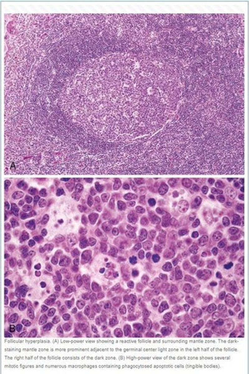 <p>Chronic nonspecific lymphadenitis features follicular hyperplasia due to stimuli activating humoral immune responses.</p>