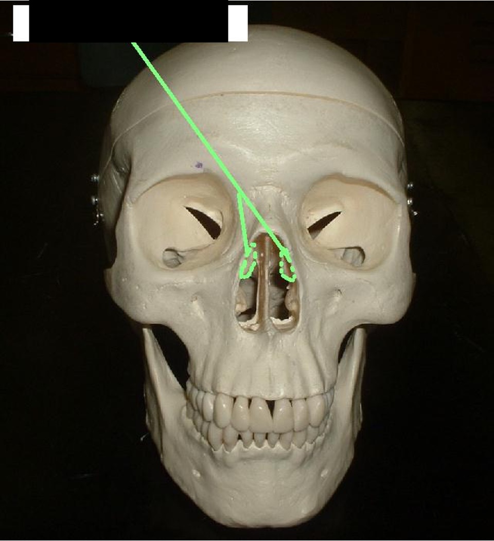 <p>one notch on both sides of the nose </p>