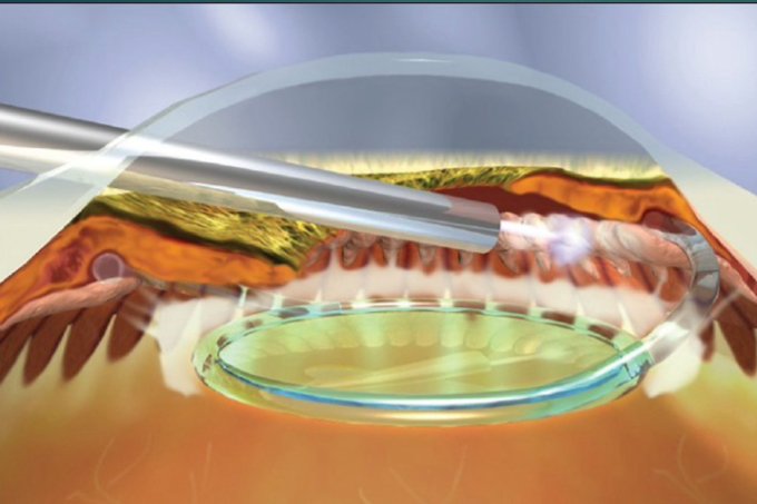 <p>What procedure is shown in the image (be specfic)?</p>