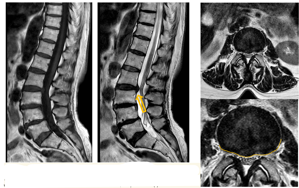 <p>Patient history: pain radiating to the right L2 dermatome, without paresis or urinary disturbance.</p><p>Modality: Non-enhanced MRI (left: T1WI sagittal, center: T2WI sagittal, right: T2W axial) </p><p>Region: lumbar spine </p><p>Radiologic sign: Btw L2/3 hypointense (signaling low water content) disc protrudes into the spinal canal (yellow arrow) </p><p></p><p>Diagnosis: disc herniation between L2 and L3 level; dehydrated disc(s)</p>