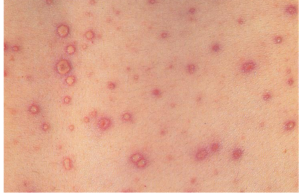 <p>what symptoms would you expect with this presentation?</p>