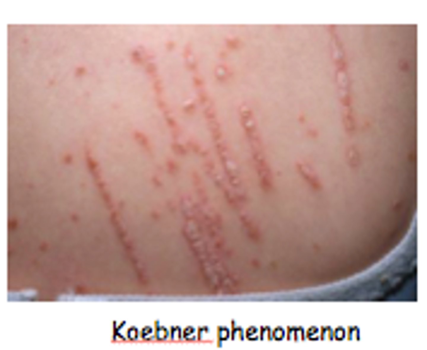<p>Koebner's phenomenon</p>