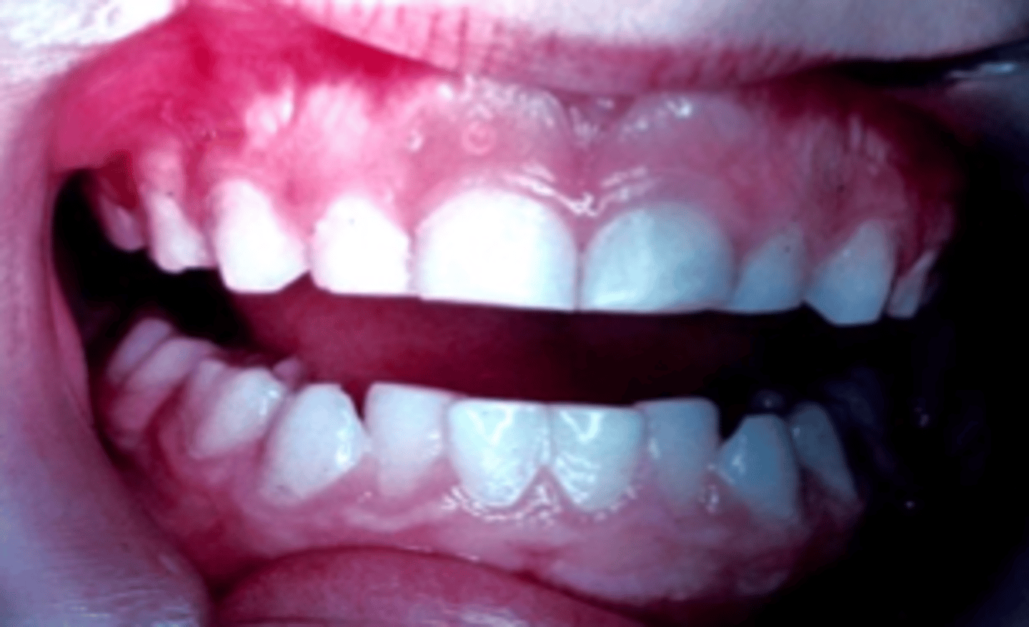 <p>ID the Baume Type:</p><p>- Without interdental spacing</p><p>- Type II Arches were on average 1.5 mm narrower in the intercanine width</p><p>- Absence of space was due to either to large primary teeth, or smaller dental arches or a combination of both</p>