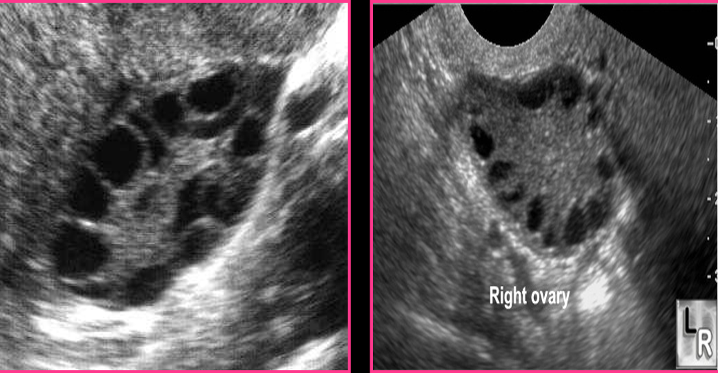 <p>Polycystic ovarian syndrome has an increased number of _____ but __________</p>