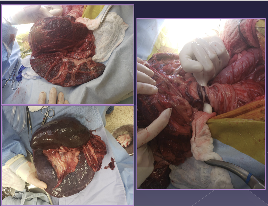 <ul><li><p>spleen twists on its vascular pedicle </p></li><li><p>large breed dogs </p></li><li><p>uncommon </p></li><li><p>acute </p><ul><li><p><strong>shock, </strong>anorexia, vomiting, diarrhea, abdominal pain, enlarged spleen </p></li></ul></li><li><p>chronic </p><ul><li><p>anorexia, vomiting, diarrhea, abdominal pain, enlarged spleen, <strong>hemoglobinuria </strong></p></li></ul></li><li><p>radiographs </p><ul><li><p>abnormal location </p></li><li><p>mass effect </p></li><li><p>gas bubbles </p></li><li><p>comma-shaped </p></li></ul></li><li><p>ultrasound </p><ul><li><p>variable echotexture </p></li><li><p>dilated vessels - gas bubbles </p></li><li><p>thrombi </p></li></ul></li><li><p>treatment </p></li><li><p>acute more urgent than chronic </p></li><li><p>cardiovascular stabilization </p></li><li><p>antibiotics - Unasyn </p></li><li><p>electrocardiogram - can cause issues with rhyme of heart so want ECG </p><ul><li><p><strong>DO NOT UN-TWIST </strong></p><ul><li><p>Necrotic debris can enter systemic circulation </p></li></ul></li></ul></li><li><p>splenectomy </p><ul><li><p>cannot and should not un-twist </p></li></ul></li></ul><p></p>