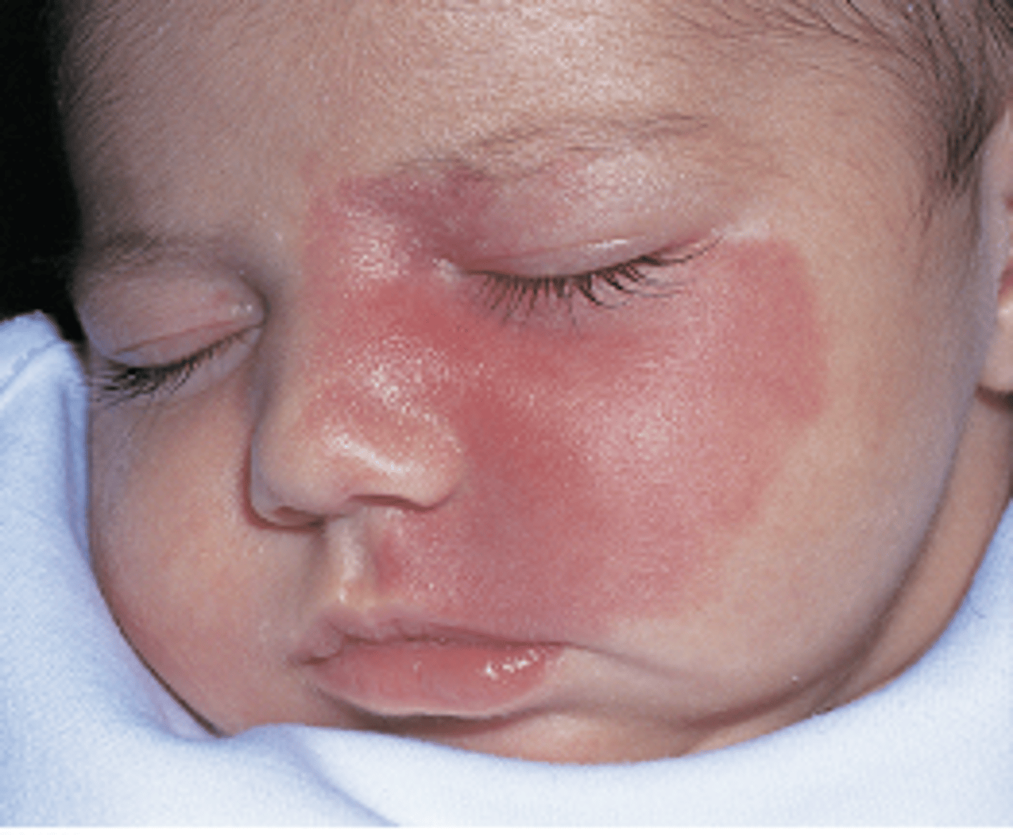 <p>pulse dye laser treatment</p>