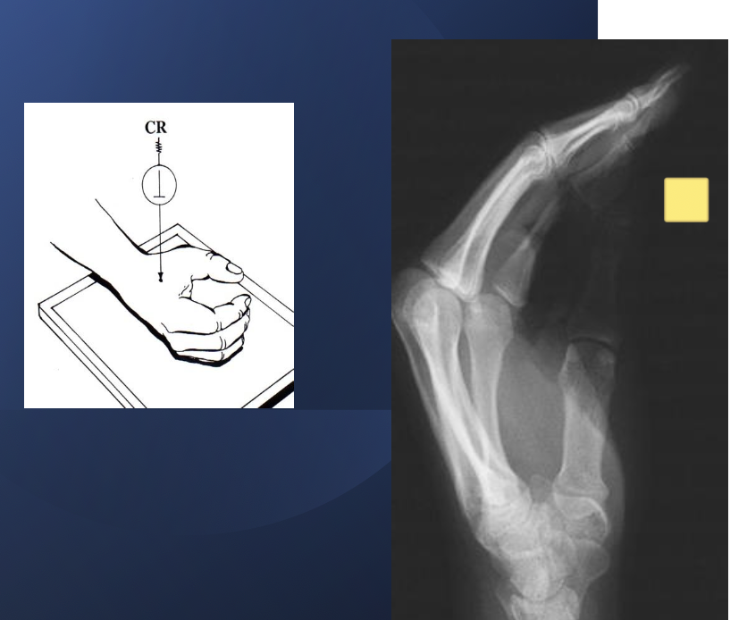 <p>relaxed lateral (hand)</p>