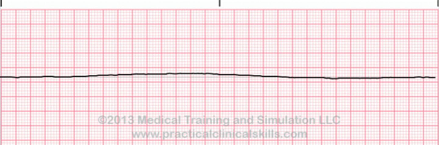 <p>"not a rhythm;" Absence of all cardiac electrical activity, represented by a flat line; indicative of clinical death.</p>