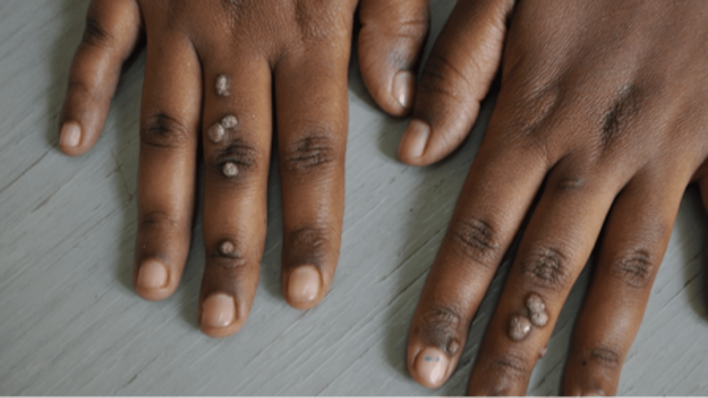 <p>name this skin pathology</p>