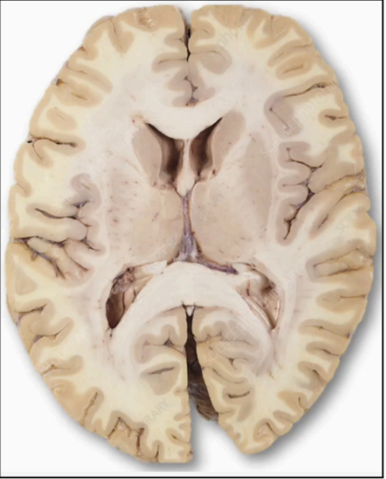 <p>Subcortical Gray Matter</p>