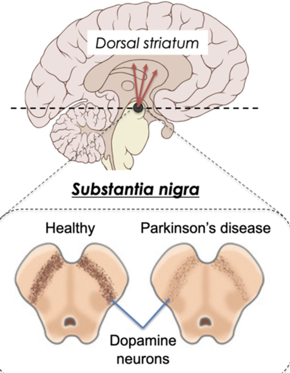 <p>1. Progressive death of dopamine neurons in substantia nigra.</p><p>2. Deposition of abnormal forms of protein (α-synuclein, superoxide dismutase 1, tau)</p>