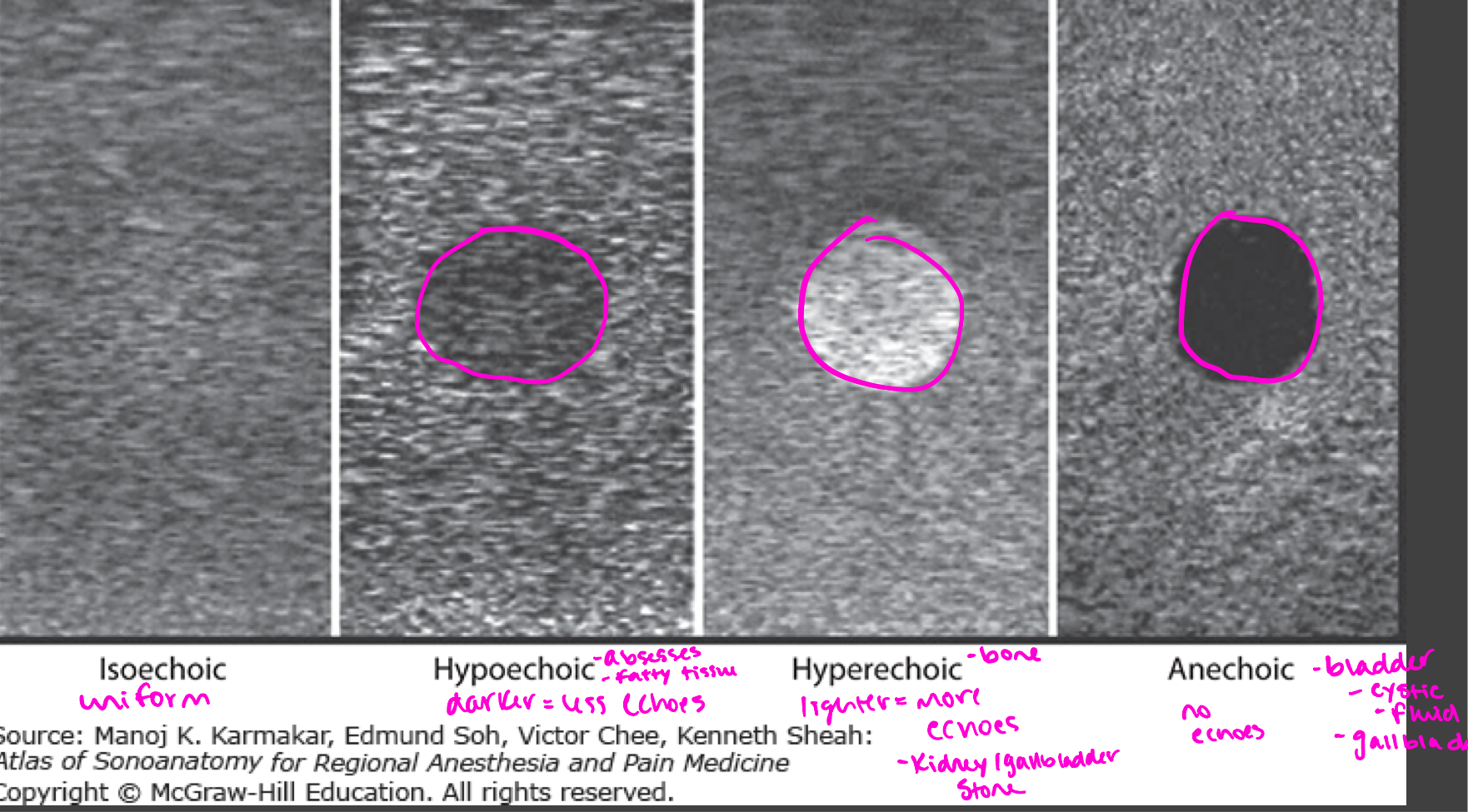 <p>Level of gray or brightness on an ultrasound image</p><p>Described in relation to surrounding tissues </p>