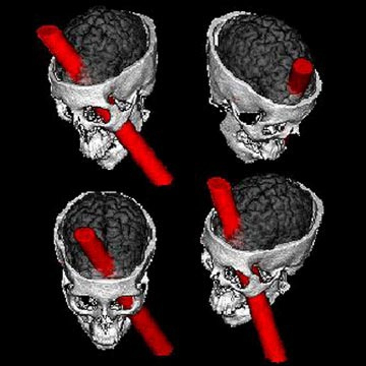 <p>1823-1860; Field: neurobiology; Contributions: 1st person to have a frontal lobotomy (by accident), his accident gave information on the brain and which parts are involved with emotional reasoning</p>
