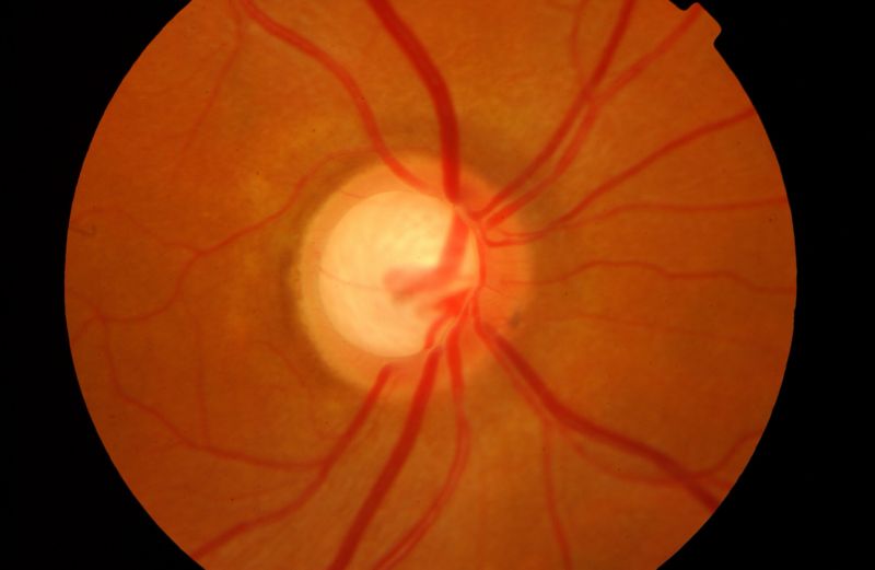 <p>Glaucoma pathology</p>