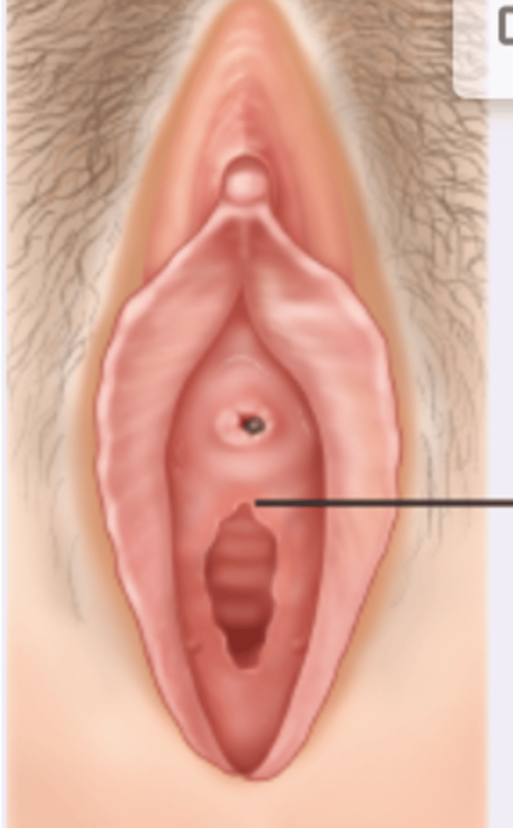 <p>small red benign tumor visible at the posterior urethral meatus</p>