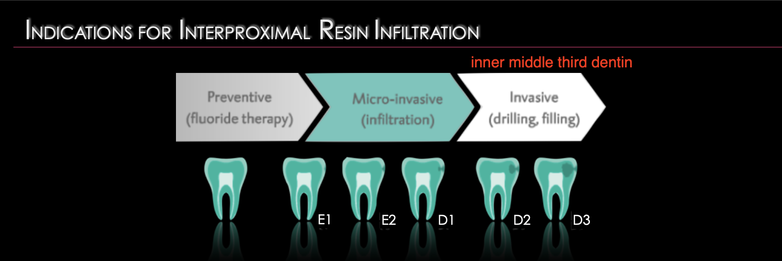 <p>E1, E2, D1</p><p>NOT D2 and D3 or inner middle third dentin</p>